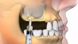 sinus lift, houston periodontal, texas periodontal, dentists, oral surgery, dental surgery